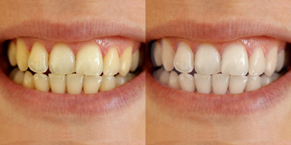 How to Whiten Teeth in Photoshop before and after